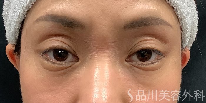 症例NO.65225のBEFORE写真
