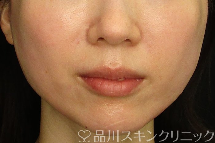 症例NO.70201のAFTER写真