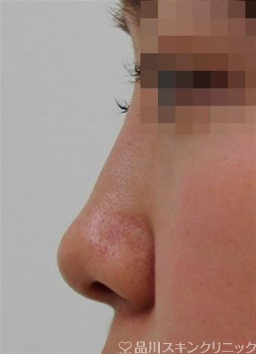 症例NO.34780のBEFORE写真