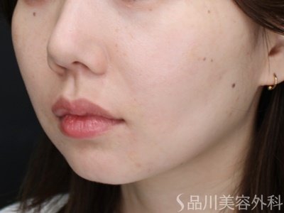 症例NO.72647のAFTER写真