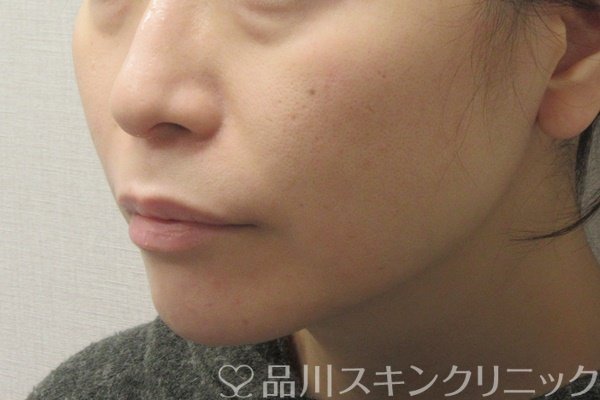 症例NO.72784のAFTER写真