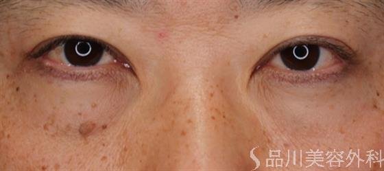 症例NO.50667のBEFORE写真