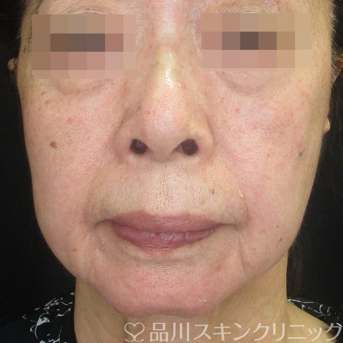 症例NO.73219のAFTER写真