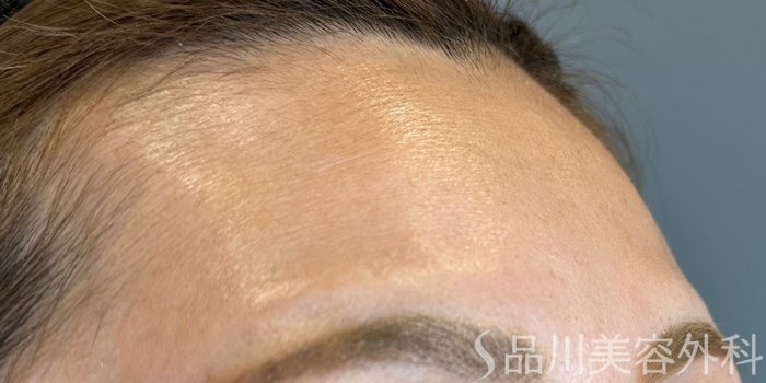 症例NO.65579のBEFORE写真