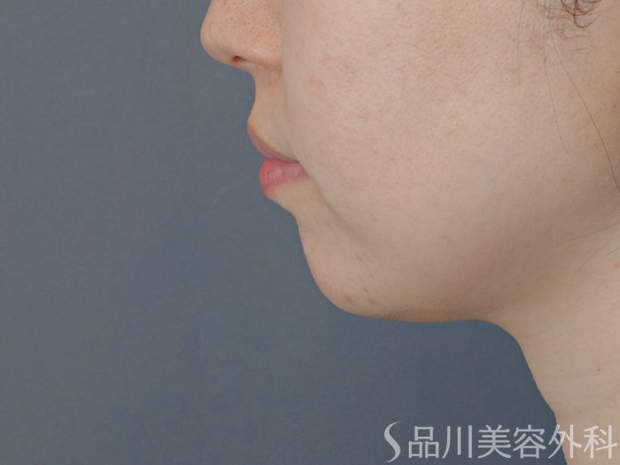 症例NO.72487のBEFORE写真