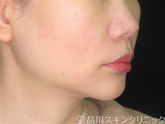 症例NO.59157のAFTER写真