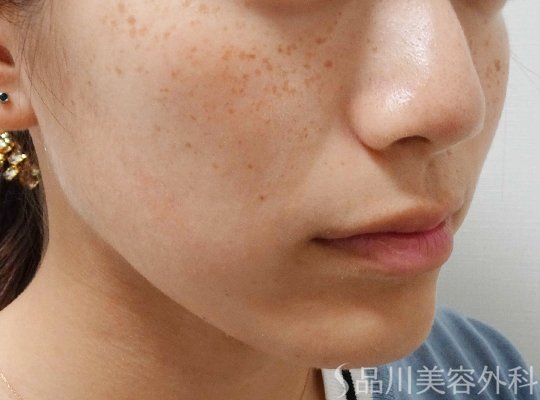 症例NO.68022のBEFORE写真