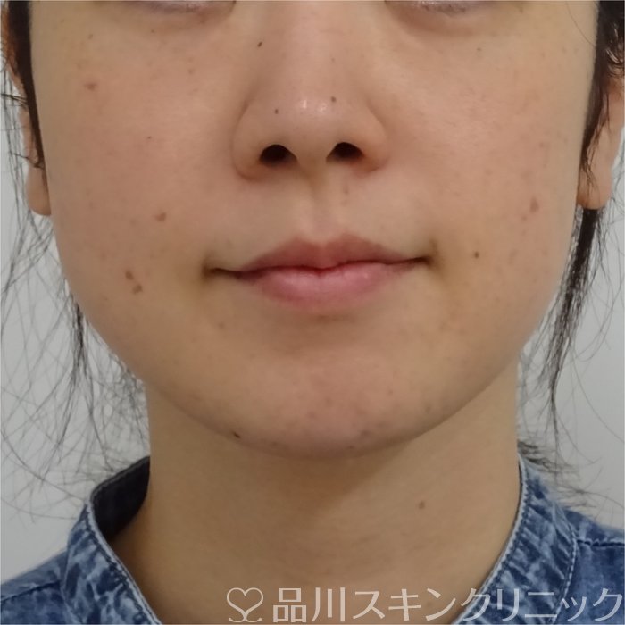 症例NO.70610のAFTER写真