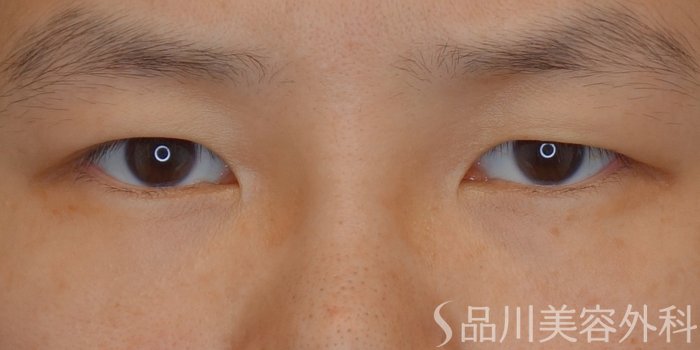 症例NO.74096のBEFORE写真