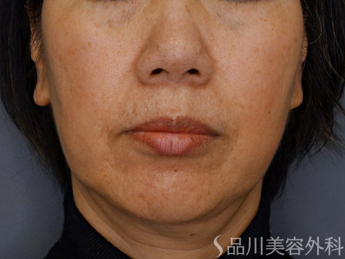症例NO.73881のBEFORE写真
