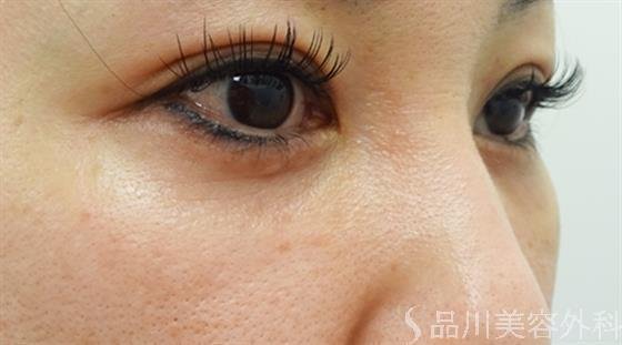 症例NO.40665のAFTER写真