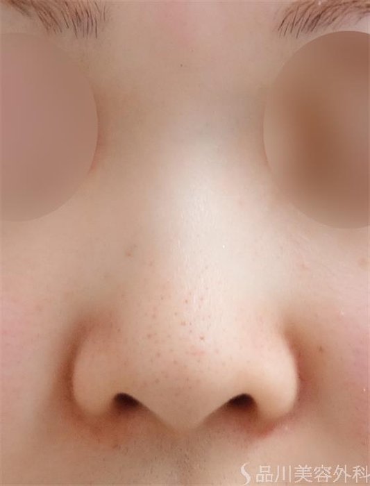 症例NO.23644のBEFORE写真