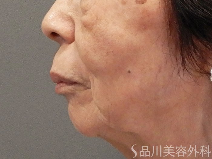 症例NO.70358のBEFORE写真