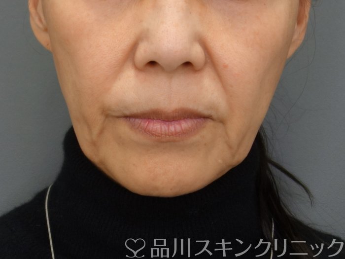 症例NO.74804のBEFORE写真
