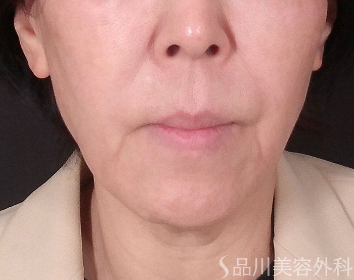 症例NO.70341のBEFORE写真