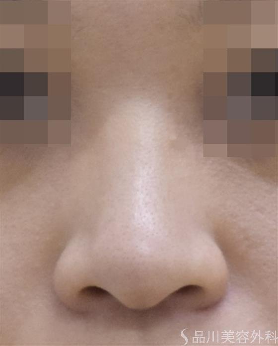 症例NO.50389のBEFORE写真