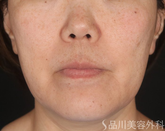 症例NO.72862のBEFORE写真