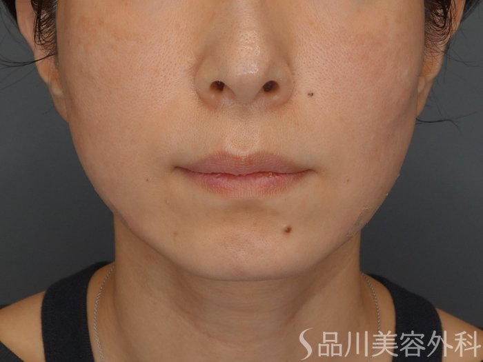 症例NO.72182のAFTER写真