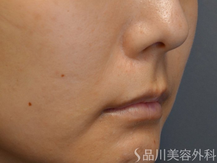 症例NO.67756のBEFORE写真