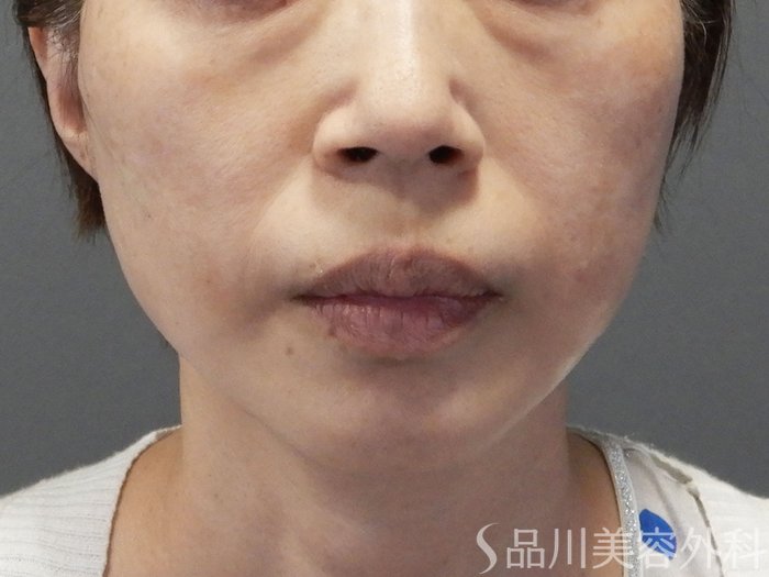 症例NO.72043のAFTER写真