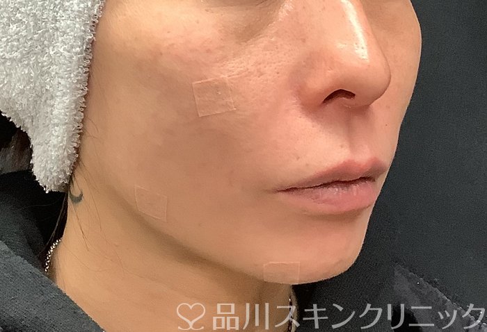症例NO.69485のAFTER写真