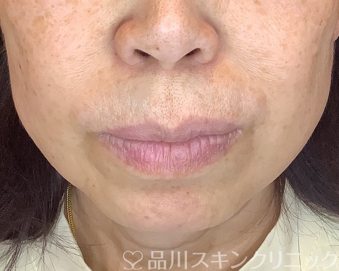 症例NO.70371のAFTER写真