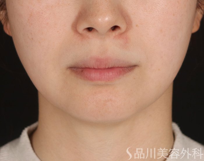 症例NO.73795のBEFORE写真