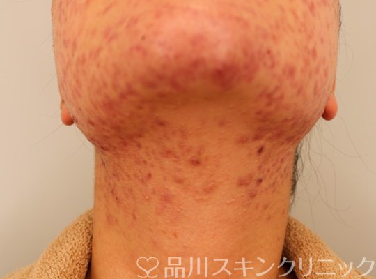 症例NO.72178のBEFORE写真