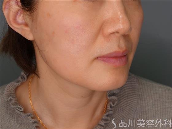 症例NO.53594のBEFORE写真