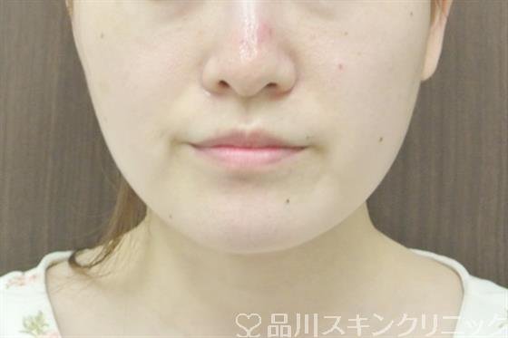 症例NO.43062のBEFORE写真