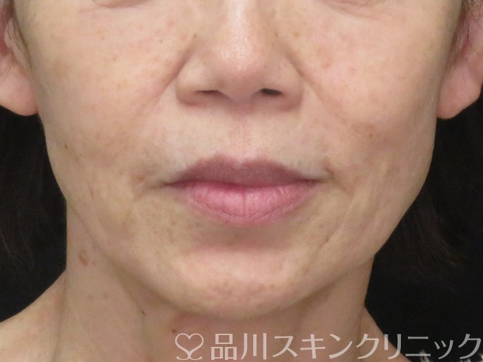 症例NO.70580のBEFORE写真