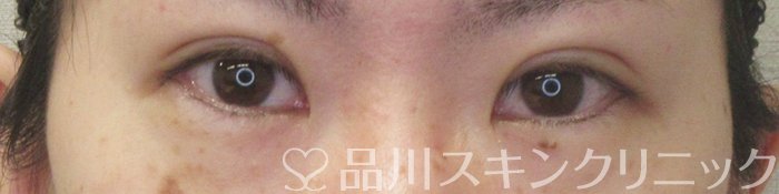 症例NO.73935のAFTER写真