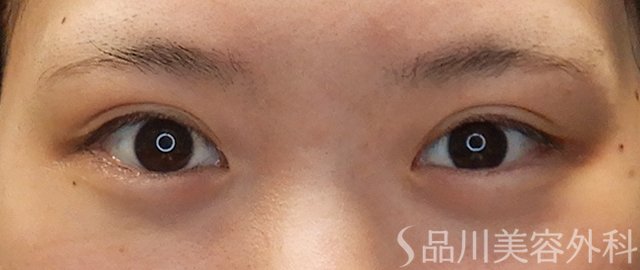 症例NO.71692のAFTER写真