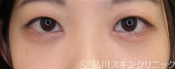 症例NO.61851のAFTER写真