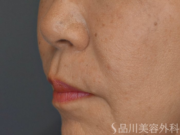 症例NO.69226のBEFORE写真