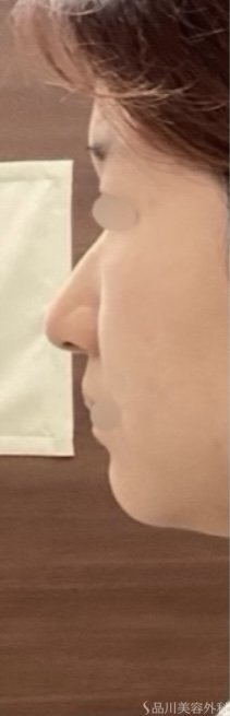 症例NO.72684のBEFORE写真