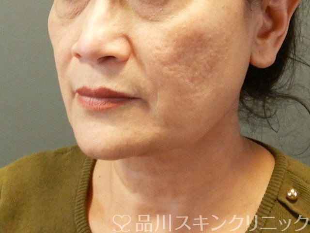 症例NO.66542のBEFORE写真