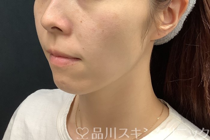 症例NO.69560のBEFORE写真