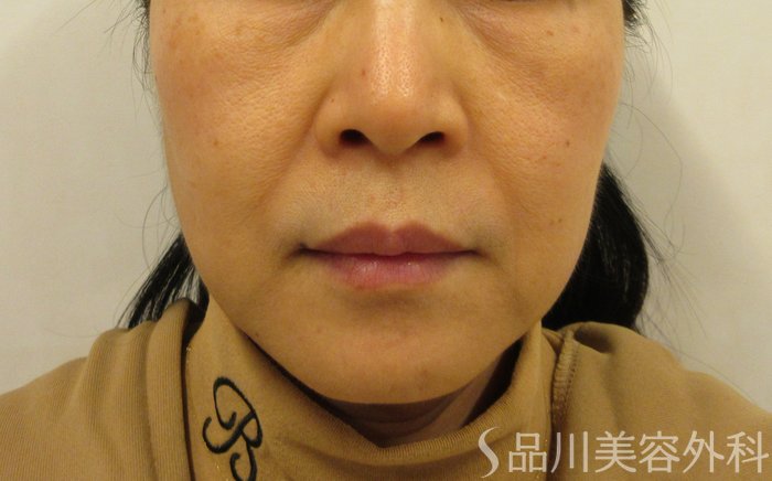 症例NO.73700のBEFORE写真