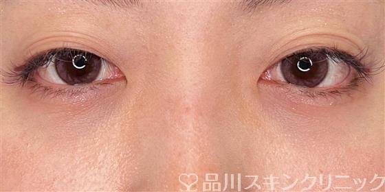 症例NO.55276のAFTER写真