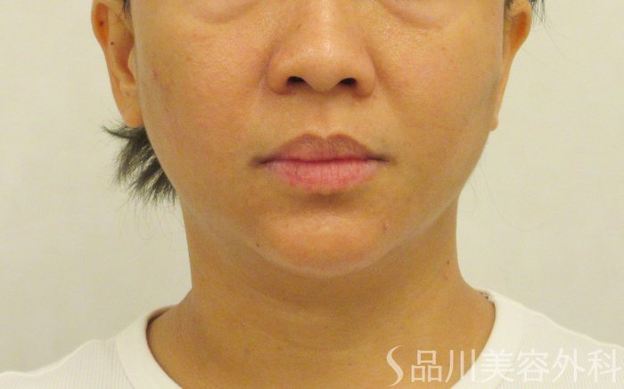 症例NO.72460のAFTER写真