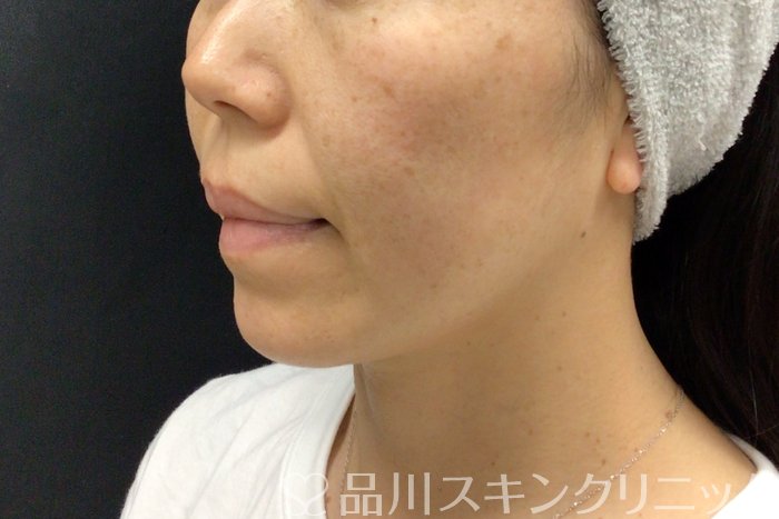 症例NO.71279のBEFORE写真