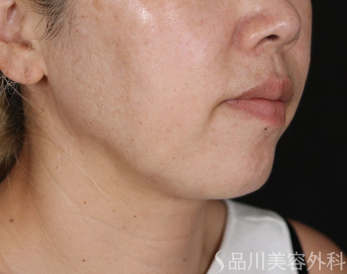 症例NO.71096のBEFORE写真