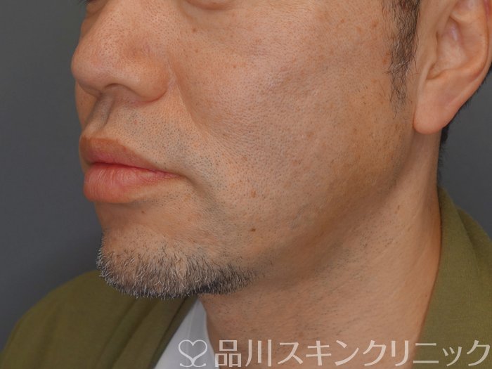 症例NO.74257のAFTER写真