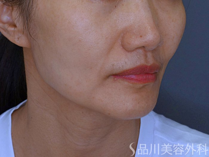 症例NO.74690のBEFORE写真