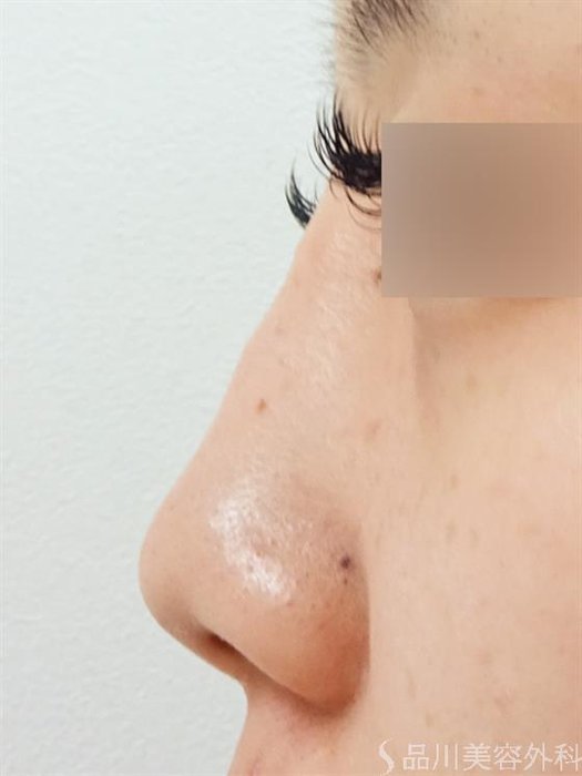 症例NO.43849のBEFORE写真