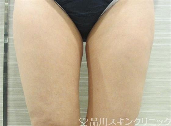 症例NO.36294のAFTER写真