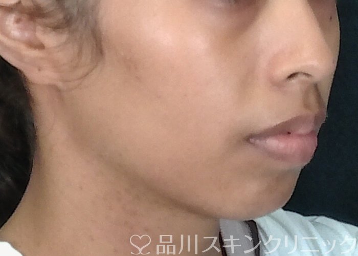 症例NO.70921のBEFORE写真