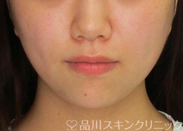 症例NO.69899のBEFORE写真