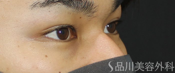 症例NO.72188のBEFORE写真